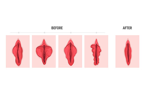 Vaginal Rejuvenation Treatment with Dr. Nupura Kashikar